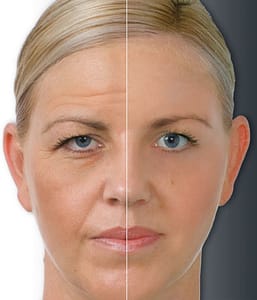 Botox 