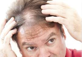 hair loss