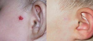 Mole Removal 