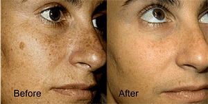 Mole Removal
