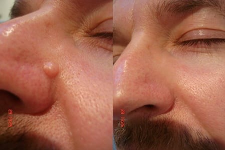 Mole Removal