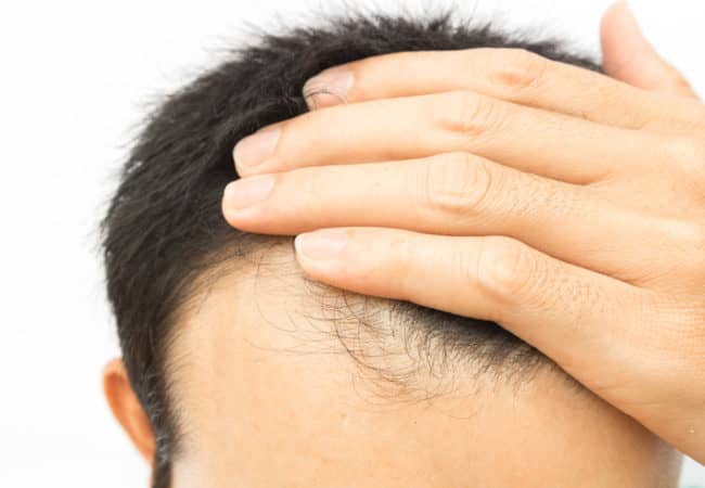 hair loss